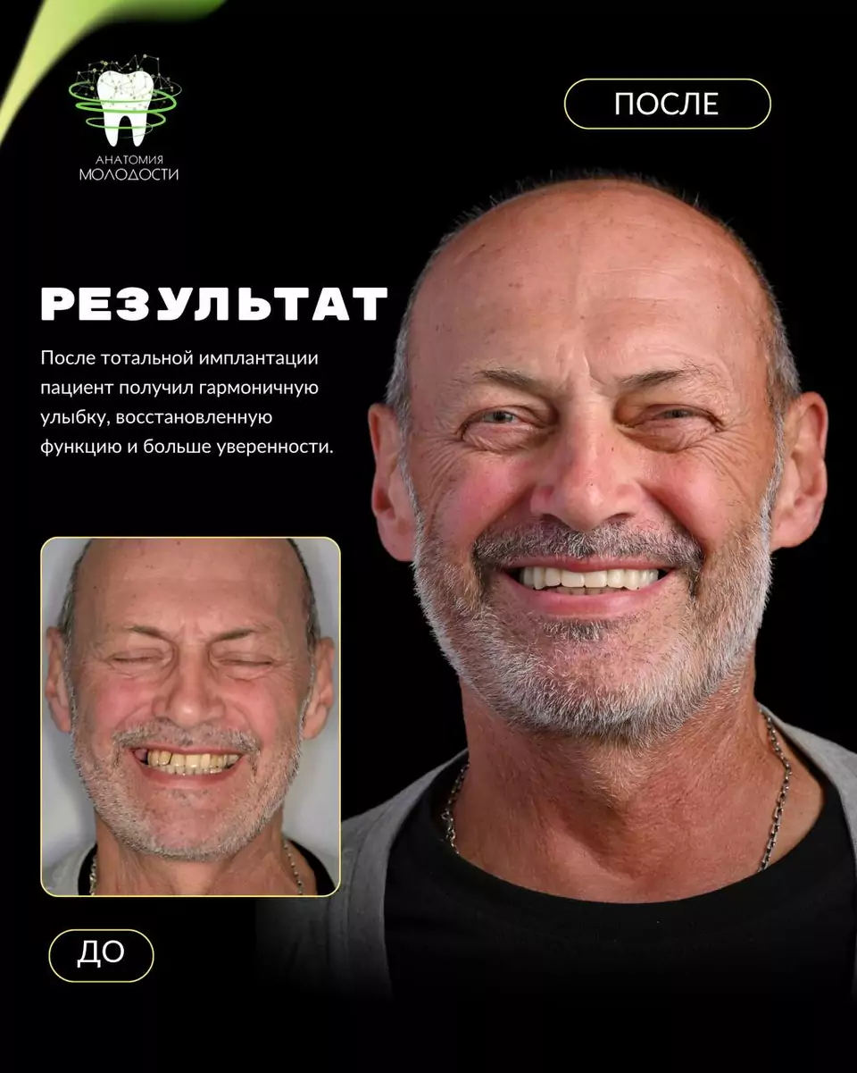 Удаление зубов, имплантация и съёмный протез, материал 5