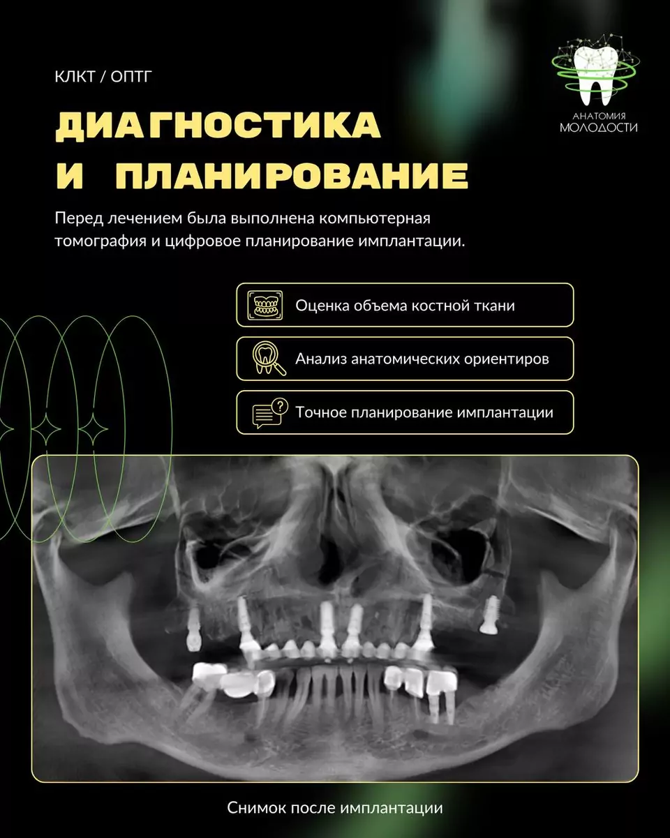 Удаление зубов, имплантация и съёмный протез, материал 3